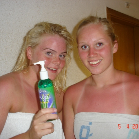 Aðeins rauðar eftir  daginn og þá kemur Aloe Vera sér vel.